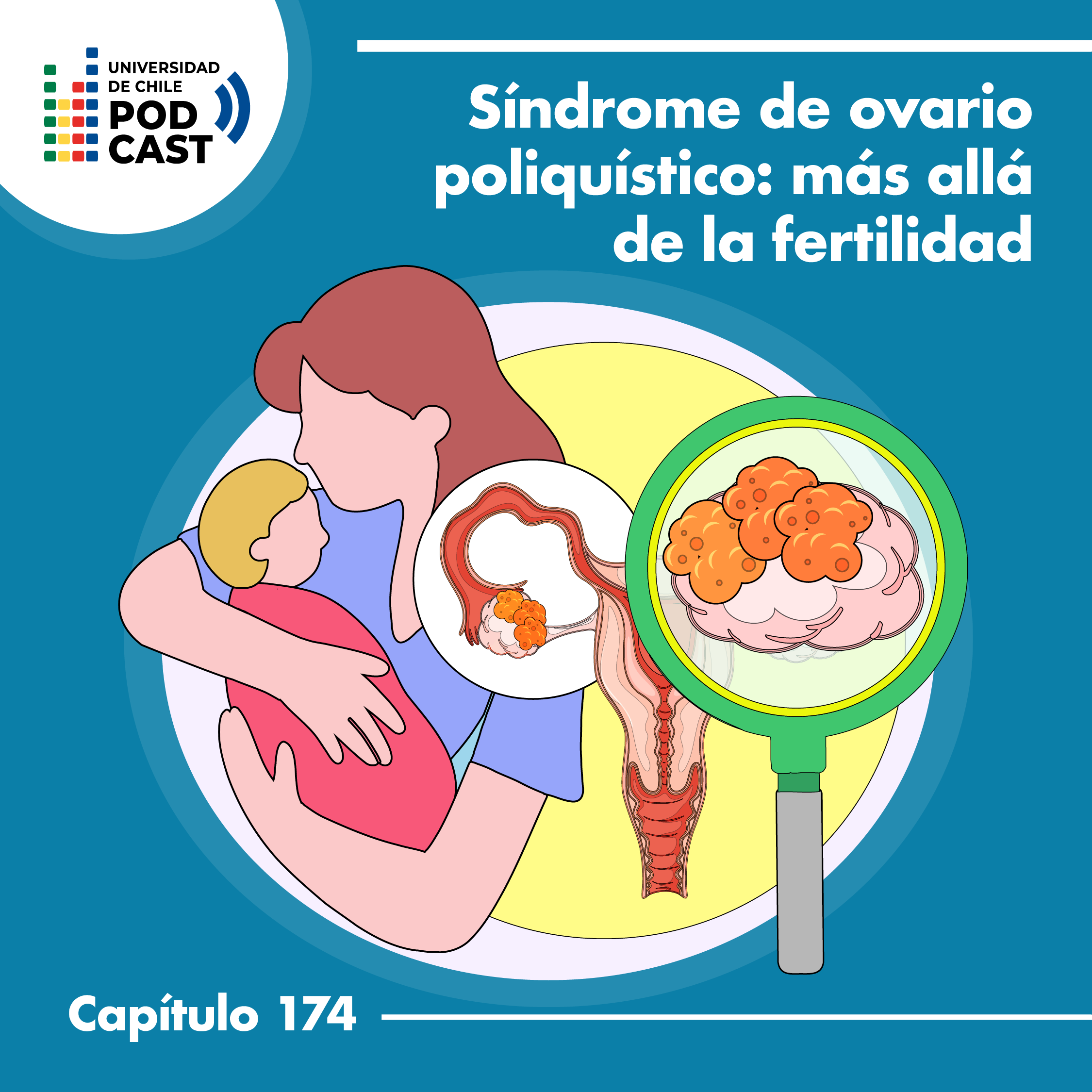 Síndrome de ovario poliquístico ¿más allá de la fertilidad?